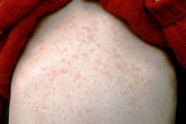 1800ss ss rm photo of measles rash